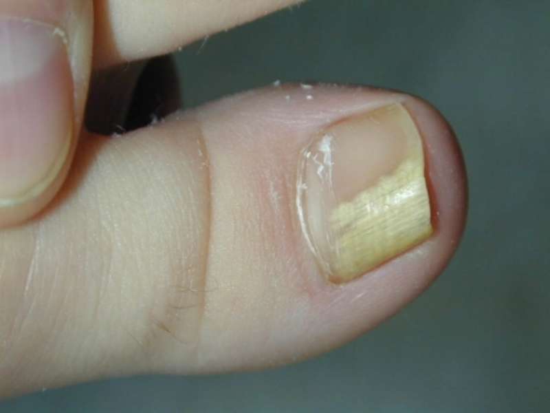 Mucegai pe unghie tratament | daltilia.es